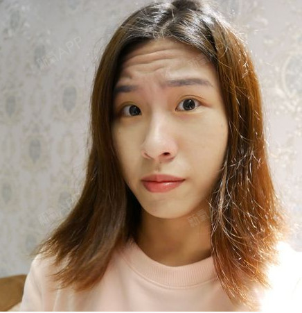 我也是在朋友的煽动下,一起去尝试了玻尿酸丰额头,手_圈子-新氧美容整