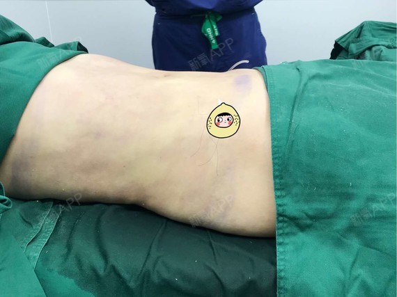 【美好尉来医美吸脂瘦腰腹术后第0天】从小到大一直都_圈子-新氧美容