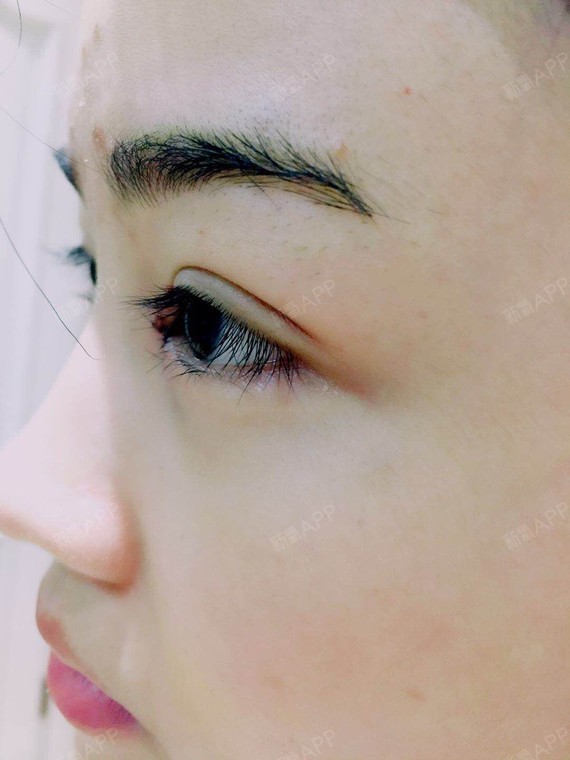 【埋线双眼皮】