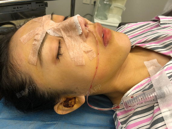 鼻部修复_修复鼻部毛囊的药_鼻部修复的方法介绍