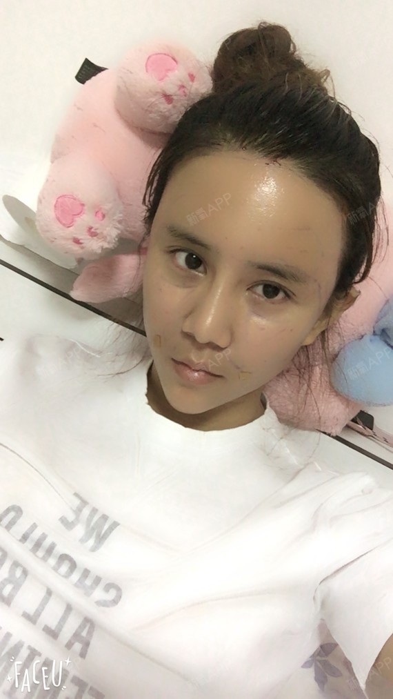 新氧- 谁谁谁45 | 自体脂肪填充全脸 | 术后当自强 | 上海同城 | 宁波