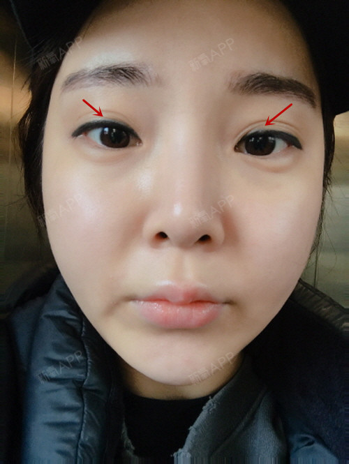 双眼皮出现褶皱