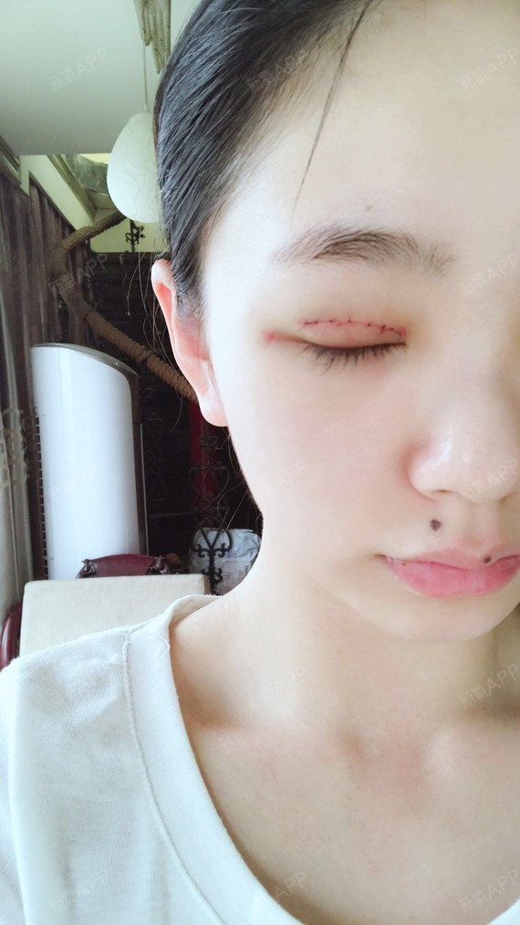 【双眼皮术后3天】术后第一二天是比较肿的,有点肿胀_圈子-新氧美容