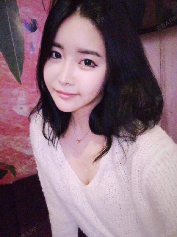 南通注射瘦脸好不好_效果图_一只叫喵喵的猪注射瘦脸术后第77天_新氧