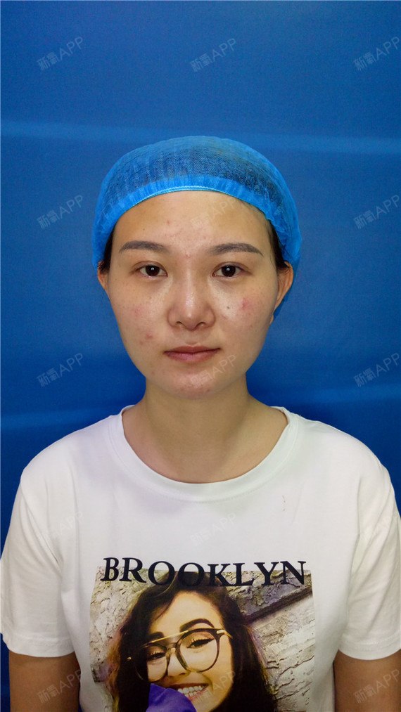 我下巴看起来短短的,更不用说翘了,一直想折腾一下.