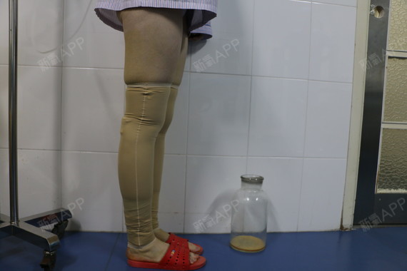 这几张照片还是护士帮忙给拍的呢 ,注意没有身后的器皿, 其实我小腿不