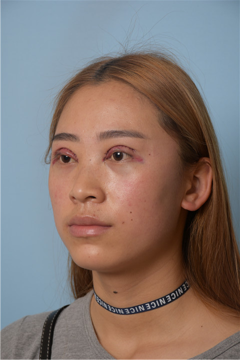 切开双眼皮怎么样_恢复过程_效果如何_韩式新整形日记4.