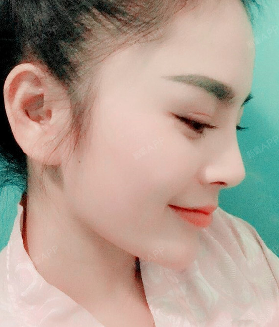 术后侧面照我很喜欢,闺蜜说侧面有点像是刘涛的鼻子了,当然我不是很