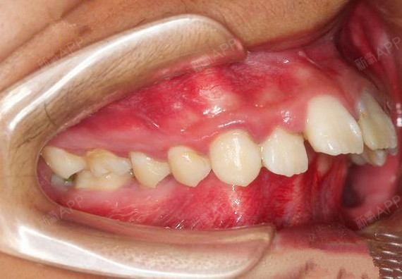 咬牙时,上前牙切端至下前牙唇面的最大水平距离超过3mm,上牙明显突出.