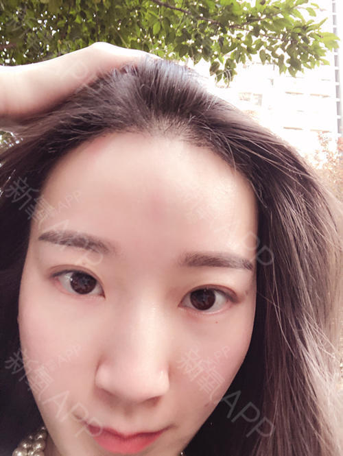 种植发际线好不好_效果图_苏sm种植发际线术后第60天_新氧美容整形
