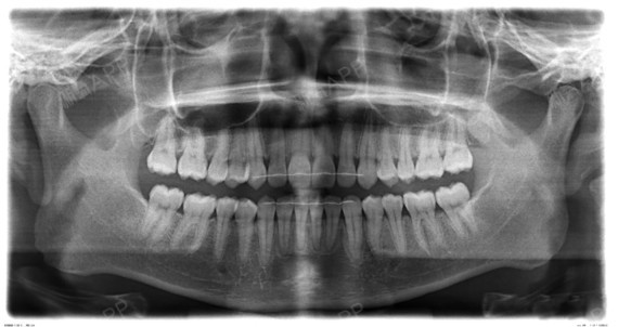 正常牙齿咬合图x光图片