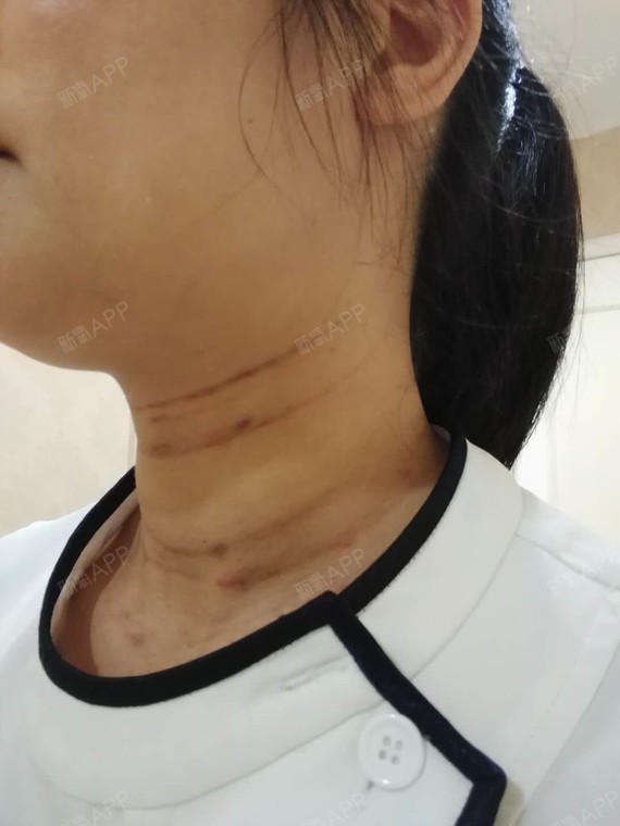 今天做了祛颈纹第三天,脖子上有些淤青,但不影响我工_圈子-新氧美容