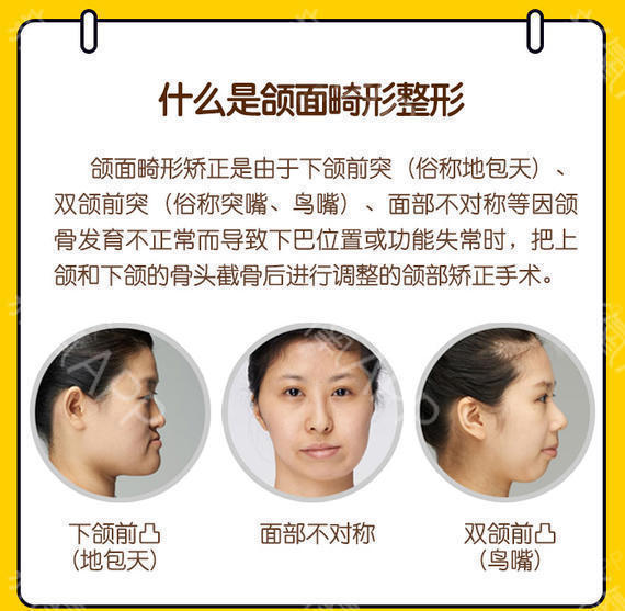 【面部不对称矫正【上海九院@袁捷主任】人工骨填充