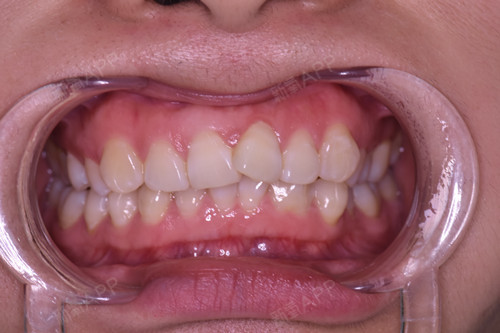 哪些小伙伴需要做美牙冠呢1、牙齿变色:如前牙