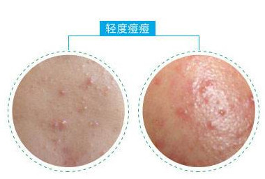 闭合性粉刺,丘疹,毛孔粗大