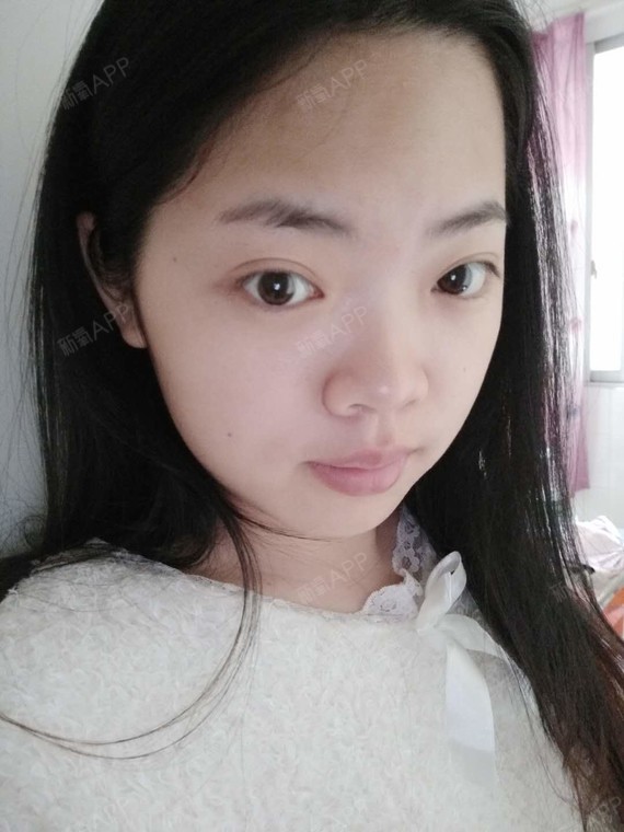 我的鼻子是典型的蒜头鼻,在五官中特别明显,鼻头宽大_圈子-新氧美容