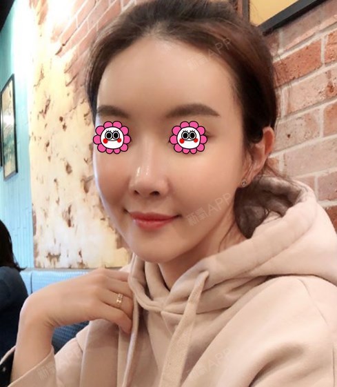 玻尿酸全脸填充好不好_效果图_溜冰公主玻尿酸全脸填充术后第30天