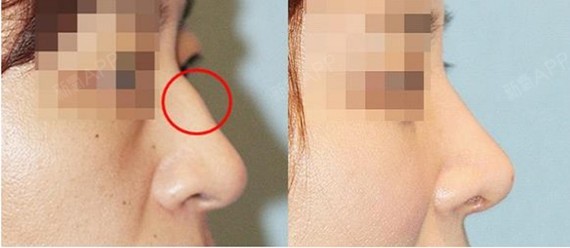 想要找到一个好老公吗 那仔细看看你的鼻子 各种鼻子 圈子 新氧美容整形