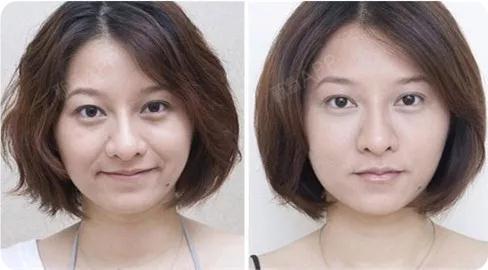 简单的看两张对比图,你就会发现,法令纹对面对整体影响有多大.