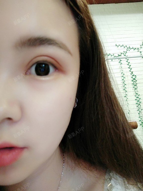 上眼睑去脂好不好_效果图_红楼萌上眼睑去脂术后第165天_新氧美容整形