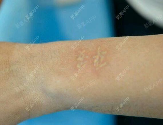 余生没有你激光去纹身第0天美丽日记