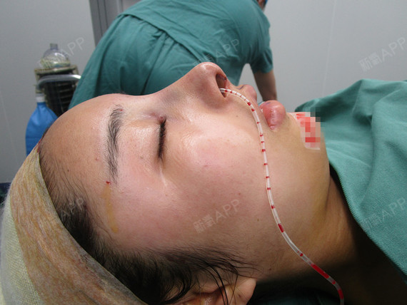 自体软骨垫鼻尖 | 术后当自强 | 松原同城 | 成都同城 | 手术缩鼻翼