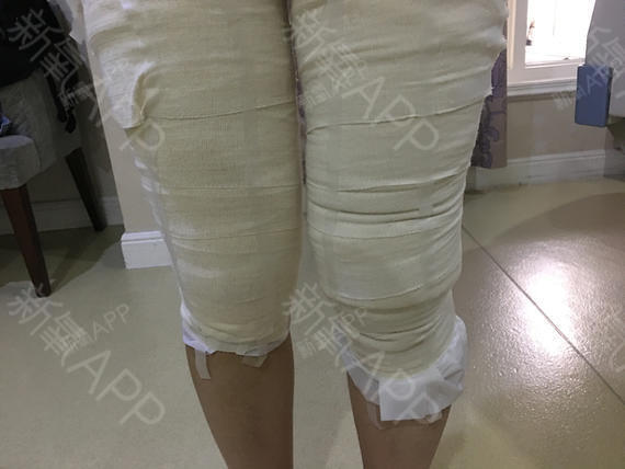 新氧- 鱼吻5411 | 美体塑形 | 吸脂瘦大腿 | 术后当自强 | 杭州同城