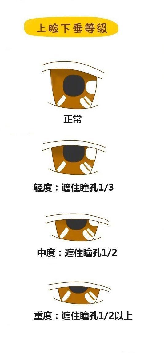 上睑下垂等级,对照看自己是哪级?(眼睛要平视)