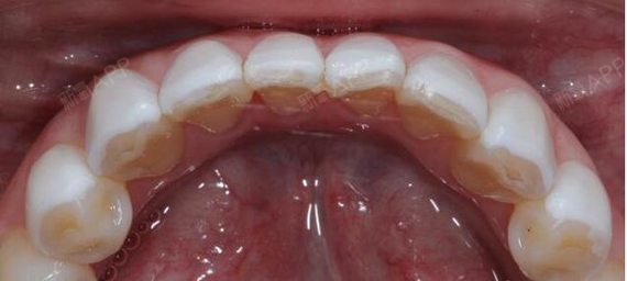 患者主诉左上前牙牙冠变色1年