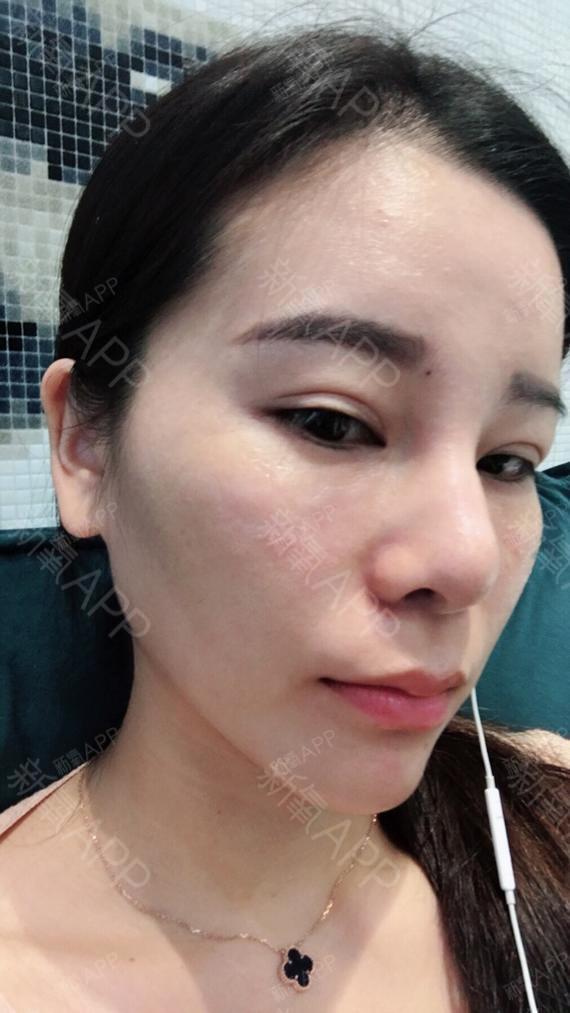 玻尿酸丰泪沟好不好_效果图_萌萌咚玻尿酸丰泪沟术后第0天_新氧美容