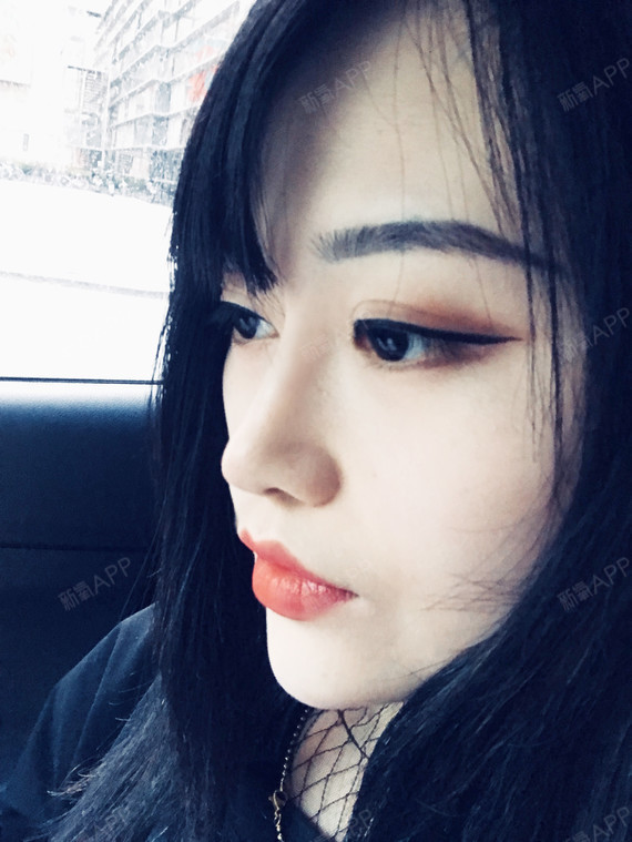 【沈阳美联致美】【异体骨隆鼻】我要来老生常谈的说一_圈子-新氧美容