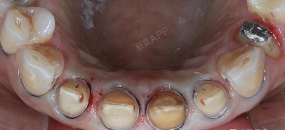 患者主诉左上前牙牙冠变色1年