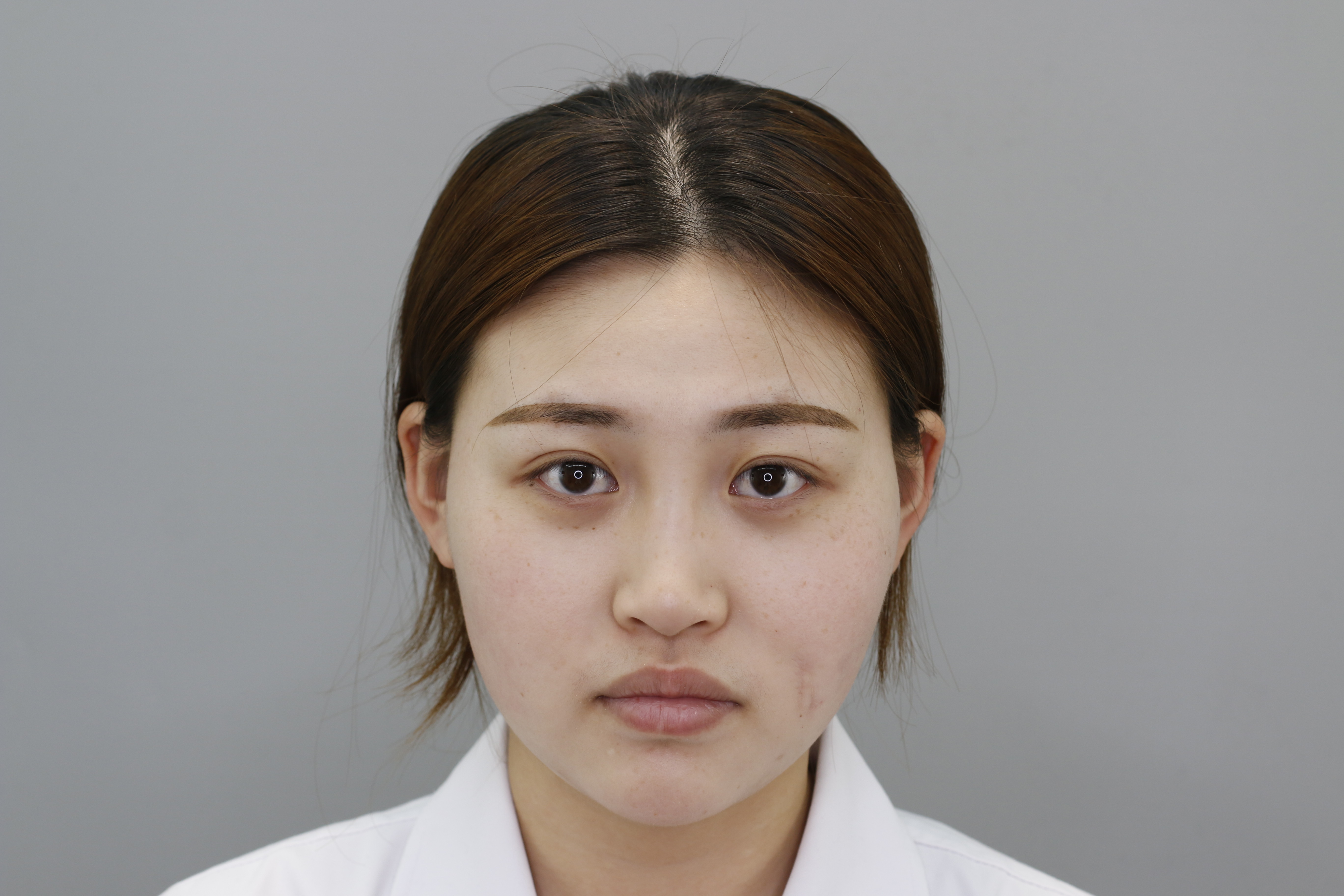 效果稳定期肉毒素瘦脸第  天           ·           第1篇日记