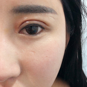 【下眼下至术第36天】【沈阳斯美诺—下眼下至第36_圈子-新氧美容整形