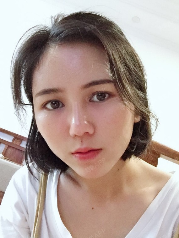 自体脂肪全脸填充好不好_效果图_唐宋元明情自体脂肪全脸填充术后第24