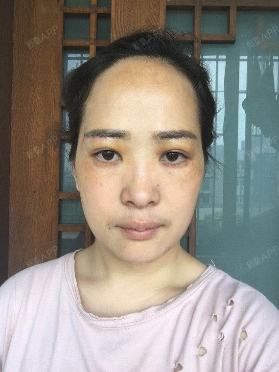 眼睛和提眉做完第7天,虽然还没完全恢复可是看整体轮_圈子-新氧美容
