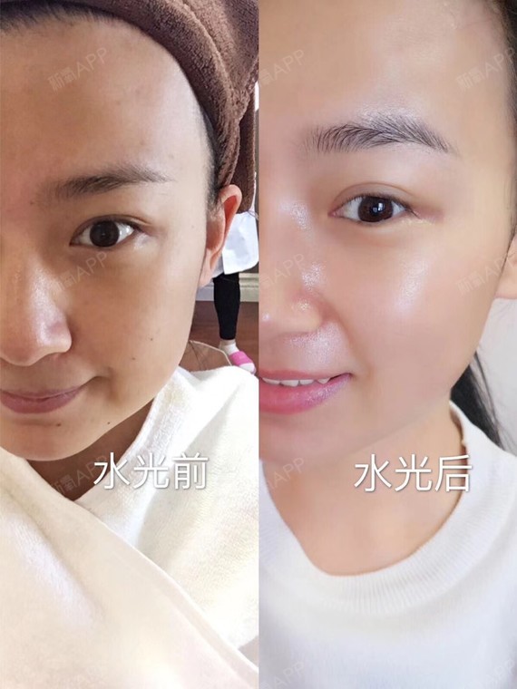 深圳无针水光好不好_效果图_富贵猫无针水光术后第0天_新氧美容整形
