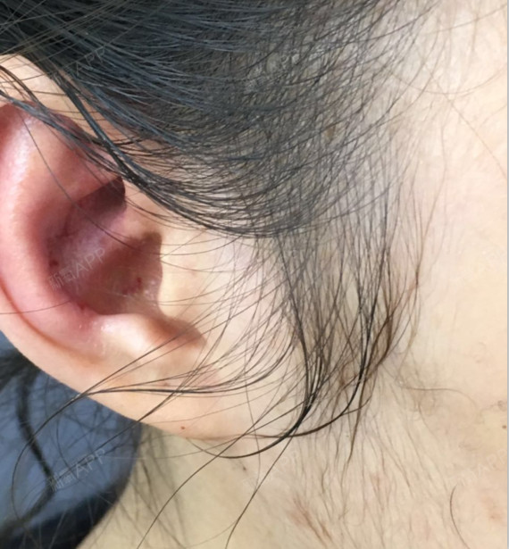 拆线一般都是第七天,我也是,因为我用的是耳软骨,所_圈子-新氧美容