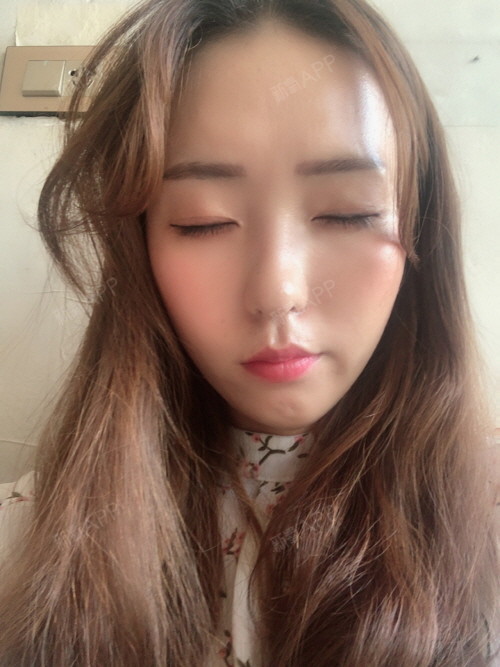 做双眼皮手术快一年啦~手术前现在闭眼侧面眼睛近点拍_圈子-新氧美容