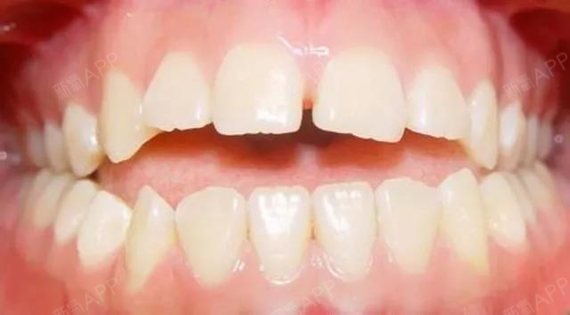 6,前牙深覆盖前牙深覆盖也被称为"撩牙",上前牙向前伸出过长(突出)