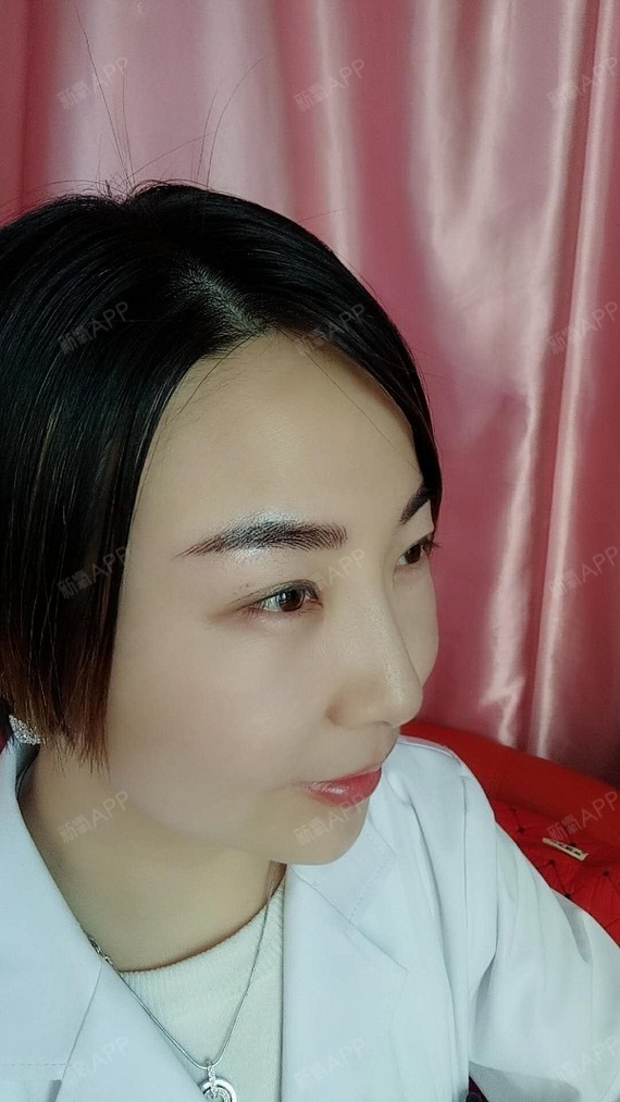 何梅梅埋线提升第3天美丽日记