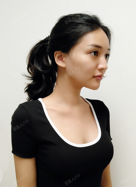 angelababy甜心假体隆胸第30天美丽日记-新氧美容整形