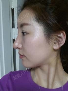 侧面线条已经非常好看了,额头现在的饱满程度正是自己_圈子-新氧美容