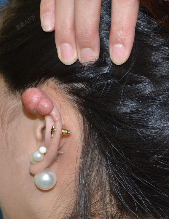 【耳部整形】耳再造