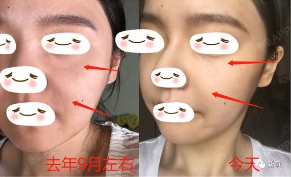 前两天羊写雪莉提到了笑肌断层,结果大家仿佛集体失忆_圈子-新氧美容