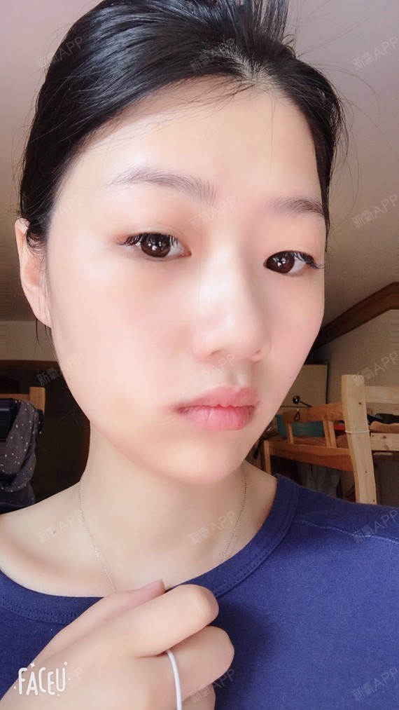 酒窝手术一周了,口腔内这几天消炎,肿胀好了很多,忌_圈子-新氧美容