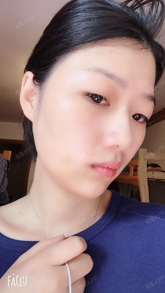 小可爱的小酒窝酒窝成形术第7天美丽日记