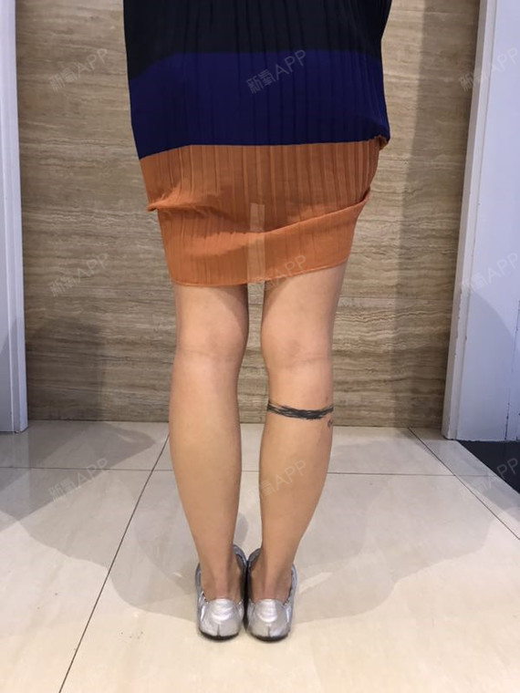 好像侧面更看得出效果,小腿肌肉那个位置好像看起来线_圈子-新氧美容