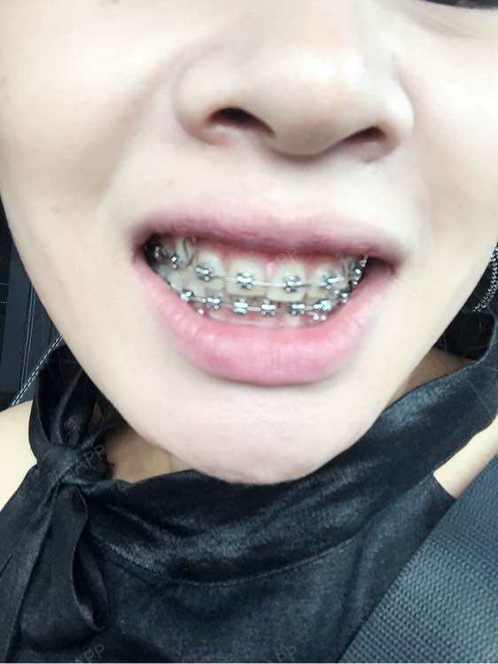 很想取牙套了,还好没有影响工作呢!业绩不错继续努力