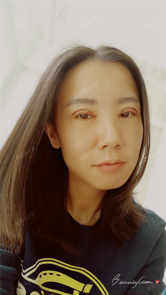 宝宝们这是刚刚做完双眼皮的第一天